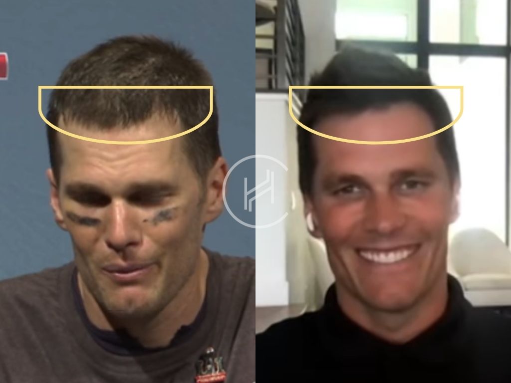 Did Tom Brady Undergo a Hair Transplant? Exploring the Truth Behind His Hairline