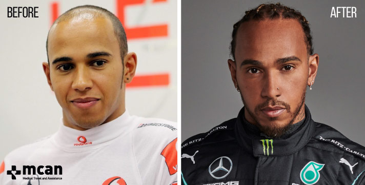 Did Lewis Hamilton Get Hair Plugs? Analyzing His Hairstyle Changes Over the Years