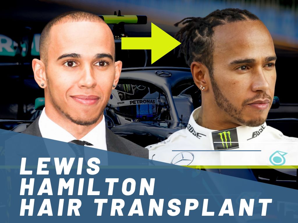 lewis hamilton losing hair