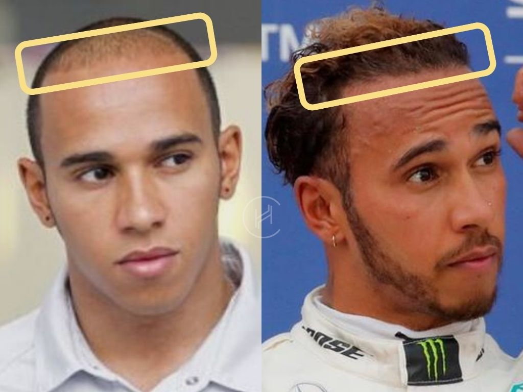 lewis hamilton losing hair