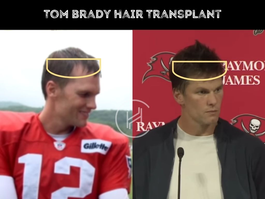 Did Tom Brady Undergo a Hair Transplant? Exploring the Truth Behind His Hairline