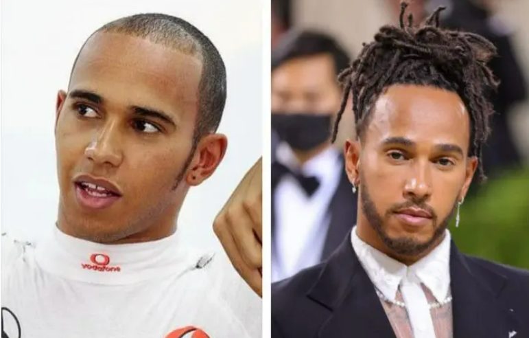 lewis hamilton losing hair
