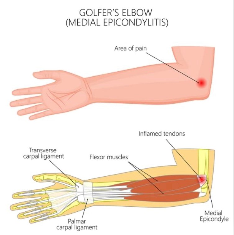 Game Operation and Tennis Elbow Understanding the Connection